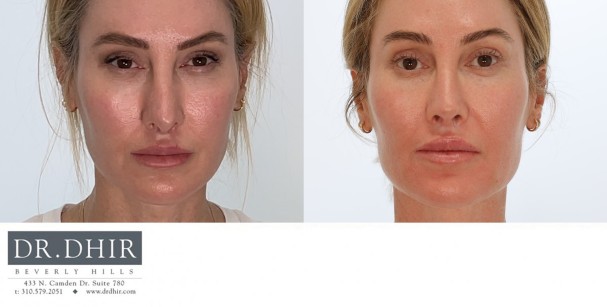 46 year old female presents for revision rhinoplasty for an overprojected, rotated and unrefined nasal tip.  She underwent a revision rhinoplasty with rib graft for tip deprojection, refinement and improvement of nostril retraction.