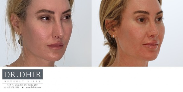 46 year old female presents for revision rhinoplasty for an overprojected, rotated and unrefined nasal tip.  She underwent a revision rhinoplasty with rib graft for tip deprojection, refinement and improvement of nostril retraction.