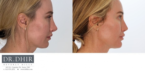 46 year old female presents for revision rhinoplasty for an overprojected, rotated and unrefined nasal tip.  She underwent a revision rhinoplasty with rib graft for tip deprojection, refinement and improvement of nostril retraction.