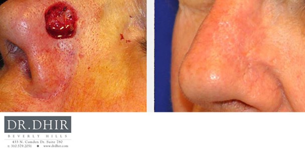 Skin-Cancer-1