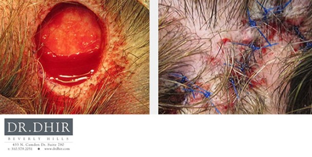 Skin-Cancer-2