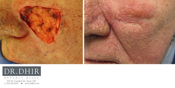 Skin-Cancer-3