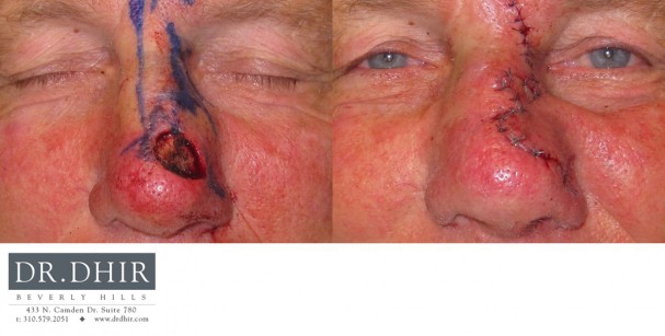 drdhir-skincancer-4-1
