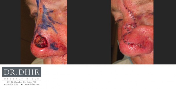 drdhir-skincancer-4-2