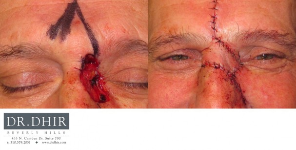 drdhir-skincancer-6-1
