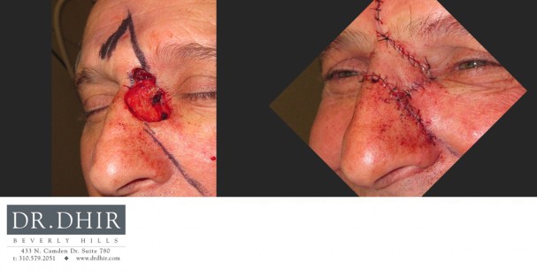 drdhir-skincancer-6-2