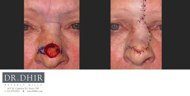 drdhir-skincancer-7-1