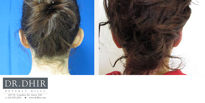 Before and After picture of a female ear surgery patient back view