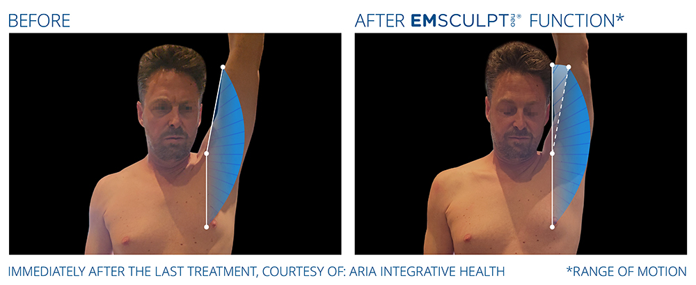 Emsculpt_Neo-Function_PIC_Ba-card-male-range-of-motion-187_ENNA100