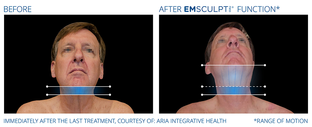 Emsculpt_Neo-Function_PIC_Ba-card-male-range-of-motion-188_ENNA100