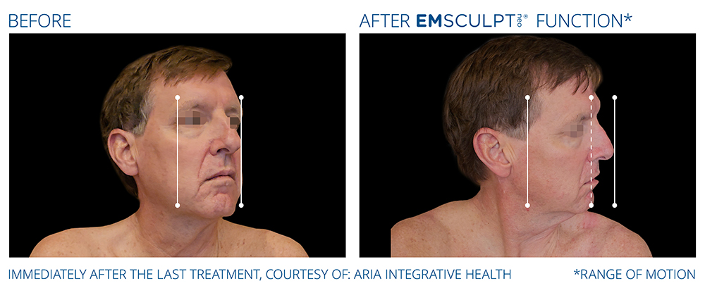 Emsculpt_Neo-Function_PIC_Ba-card-male-range-of-motion-189_ENNA100