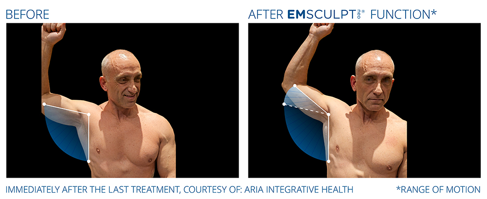 Emsculpt_Neo-Function_PIC_Ba-card-male-range-of-motion-190_ENNA100