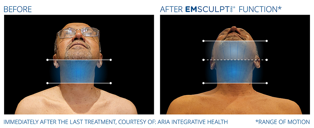 Emsculpt_Neo-Function_PIC_Ba-card-male-range-of-motion-191_ENNA100