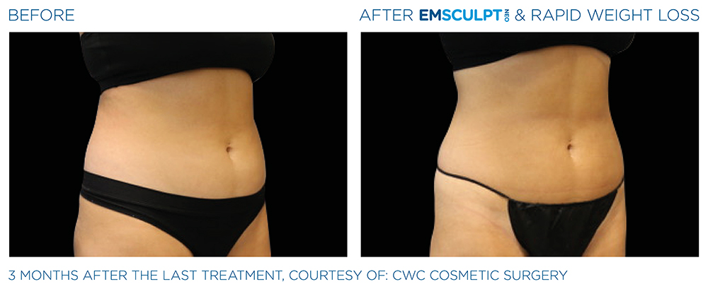 Emsculpt_Neo-Weight-Loss_PIC_Ba-card-female-abdomen-006_ENUS100