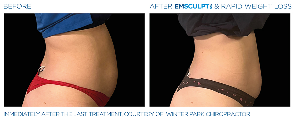 Emsculpt_Neo-Weight-Loss_PIC_Ba-card-female-abdomen-012_ENUS101