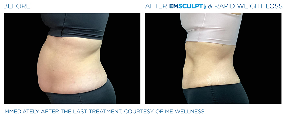 Emsculpt_Neo-Weight-Loss_PIC_Ba-card-female-abdomen-015_ENUS100
