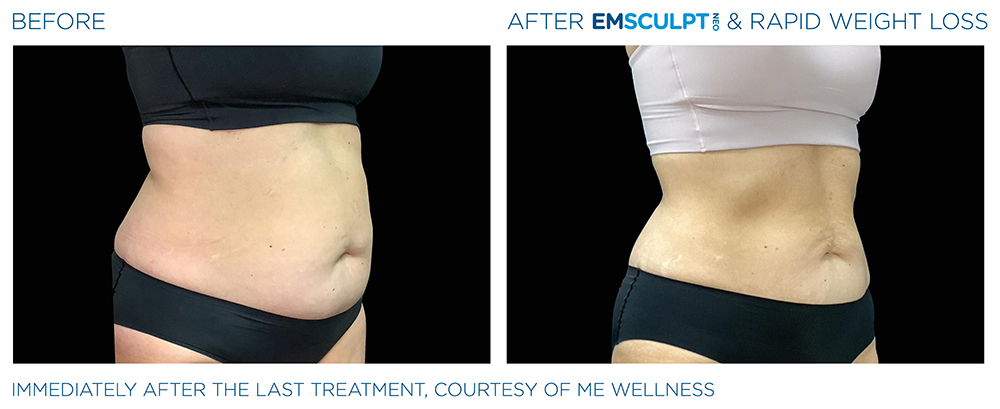 Emsculpt_Neo-Weight-Loss_PIC_Ba-card-female-abdomen-016_ENUS100