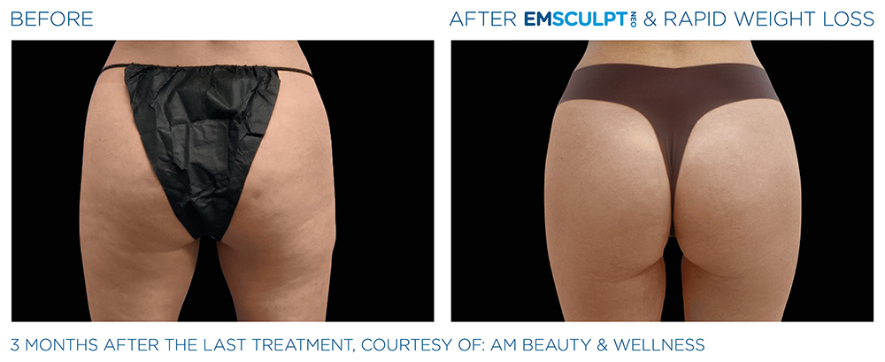 Emsculpt_Neo-Weight-Loss_PIC_Ba-card-female-buttocks-005_ENUS100