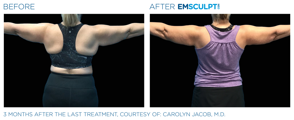 Emsculpt_Neo_PIC_Ba-card-female-arms-078-B_ENUS100