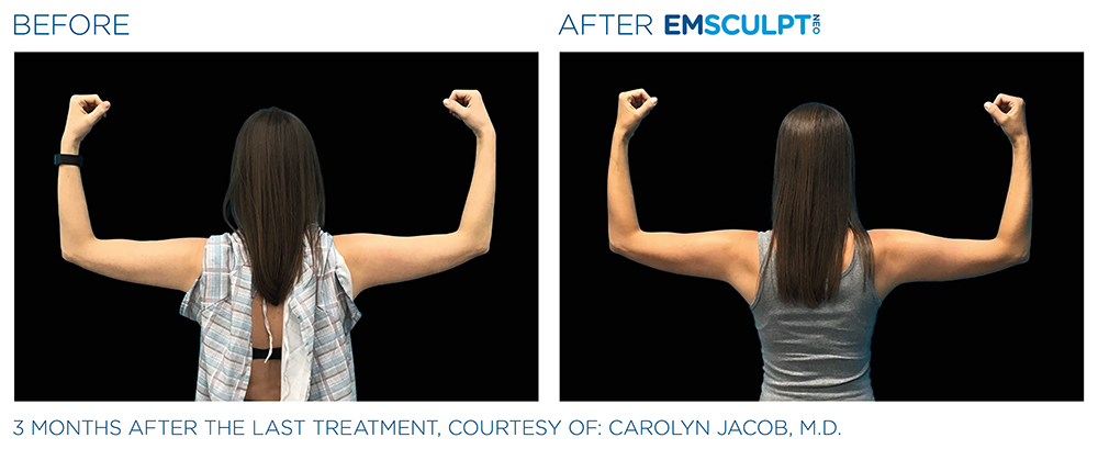 Emsculpt_Neo_PIC_Ba-card-female-arms-079-B_ENUS100