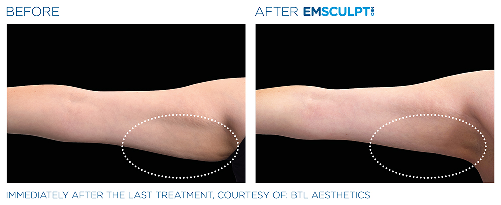 Emsculpt_Neo_PIC_Ba-card-female-arms-099_ENUS100