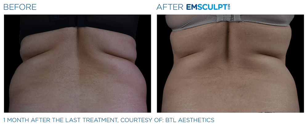 Emsculpt_Neo_PIC_Ba-card-female-lateral-abdomen-118_ENUS100