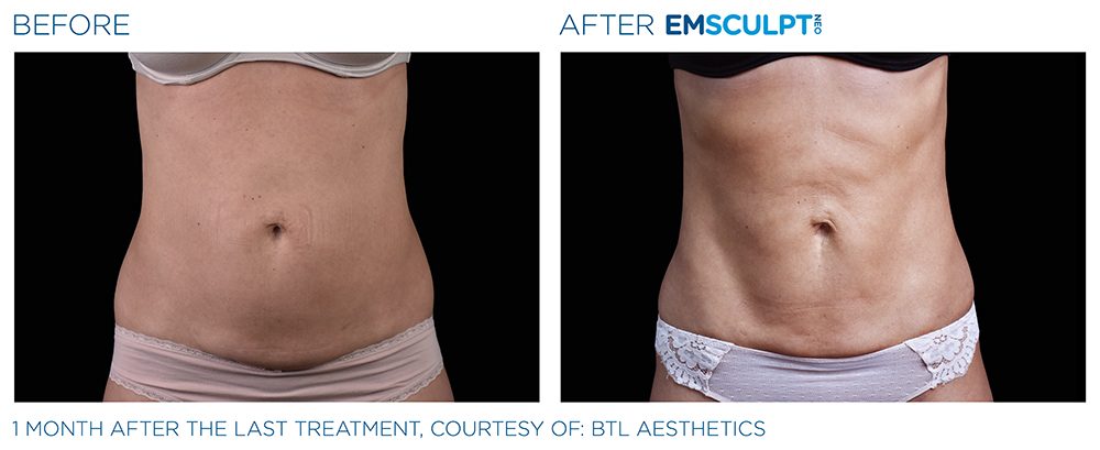 Emsculpt_Neo_PIC_Ba-card-female-lateral-abdomen-120_ENUS100