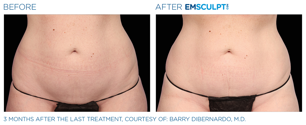 Emsculpt_Neo_PIC_Ba-card-female-lateral-abdomen-141_ENUS100