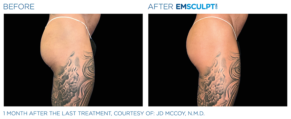 Emsculpt_Neo_PIC_Ba-card-male-buttock-088_ENUS100