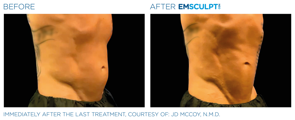 Emsculpt_Neo_PIC_Ba-card-male-lateral-abdomen-123_ENUS100