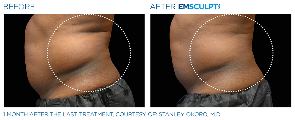 Emsculpt_Neo_PIC_Ba-card-male-lateral-abdomen-166_ENUS100