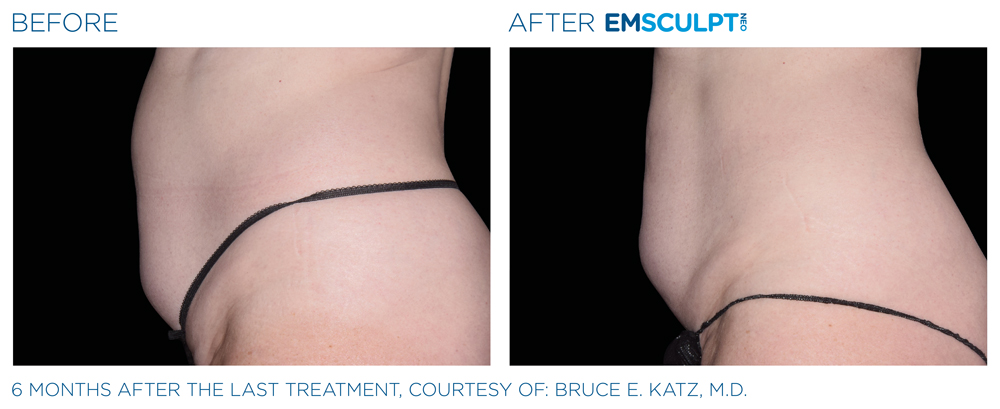 Emsculpt_neo_PIC_Ba-card-female-abdomen-036_ENUS100