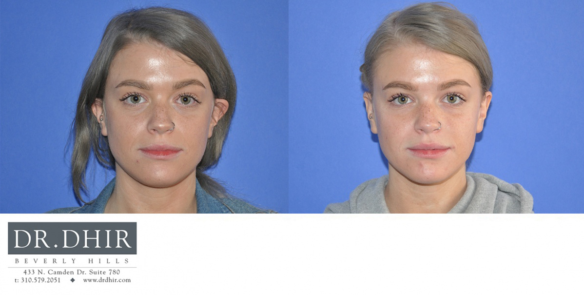 Before and After picture of a female Blepharoplasty patient front view