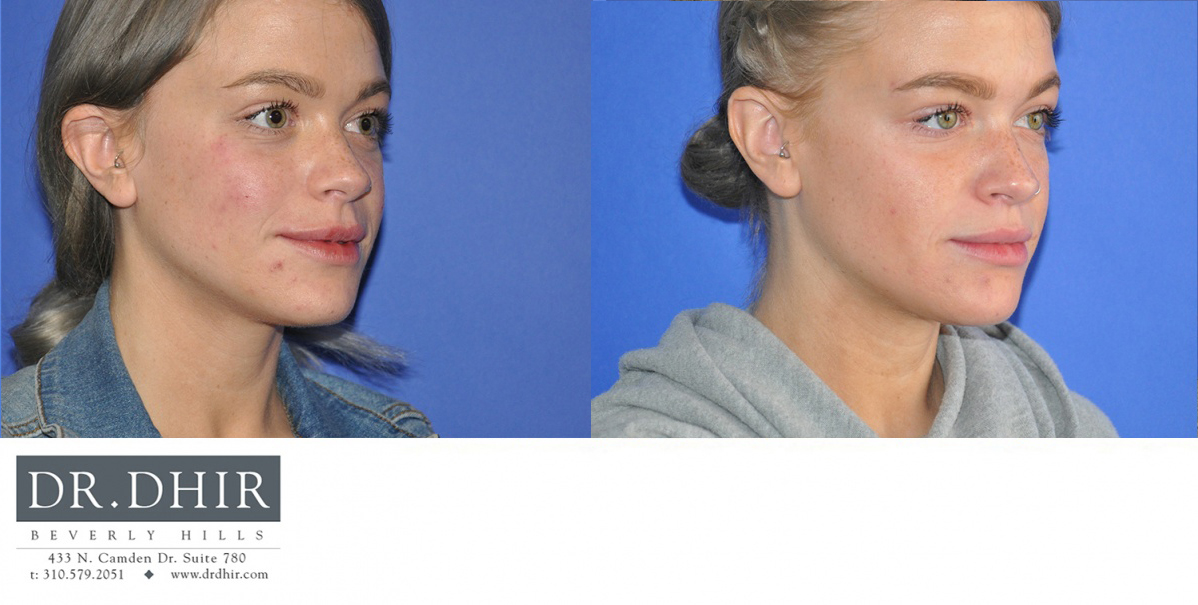 Before and After picture of a female Blepharoplasty patient 3/4th view