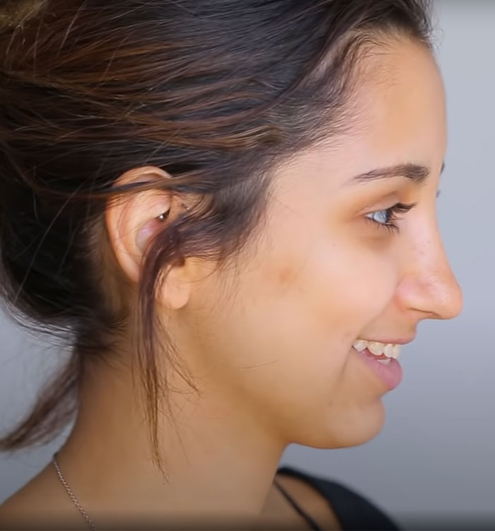 Side view of a female Rhinoplasty patient