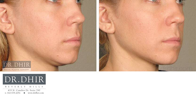 a woman's face before and after image