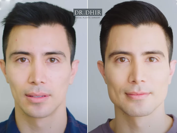 Before and after picture of a jaw implants male patient front view