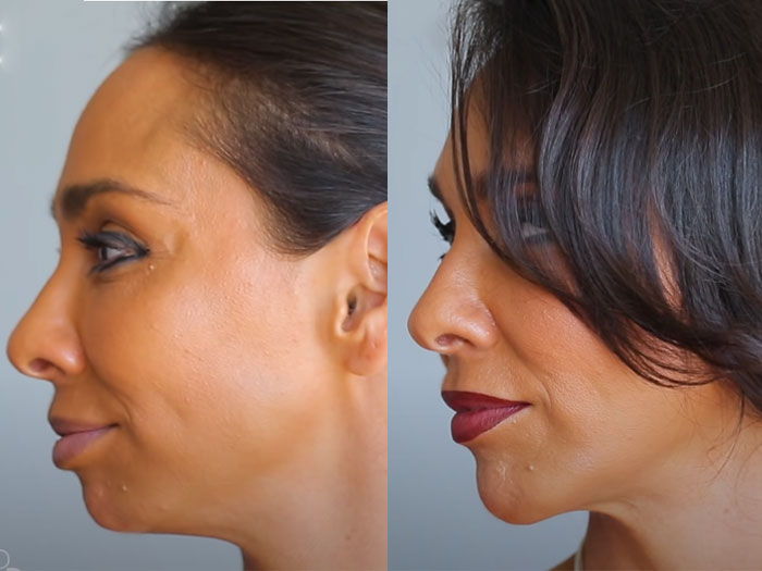 Side view of Before and After picture of a female patient of facial implants