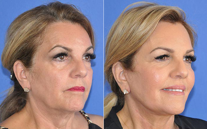 Before and After picture of a female facelift patient 3/4th view