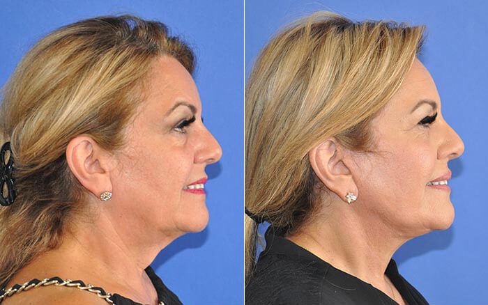 Before and After picture of a female facelift patient side view