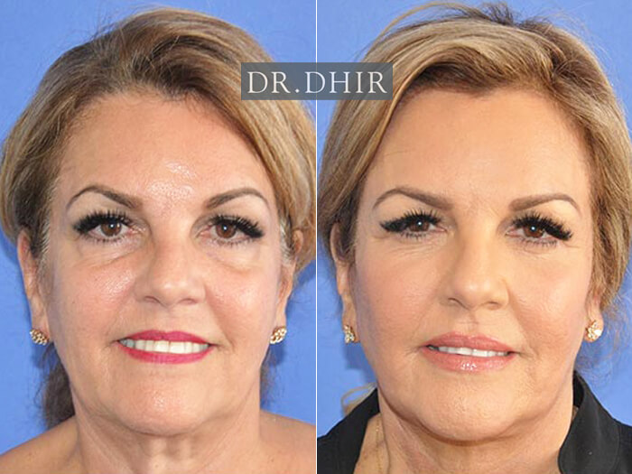 Before and After picture of a filler augmentation female patient