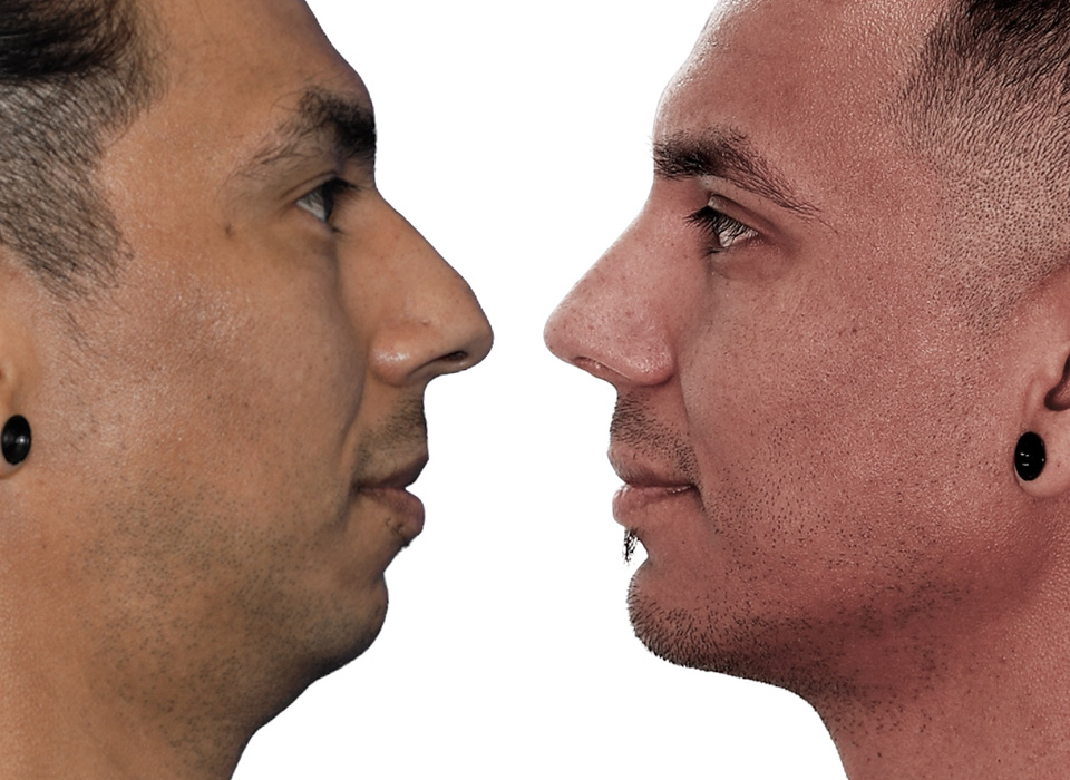 Before and After picture of a Jaw Implants male patient