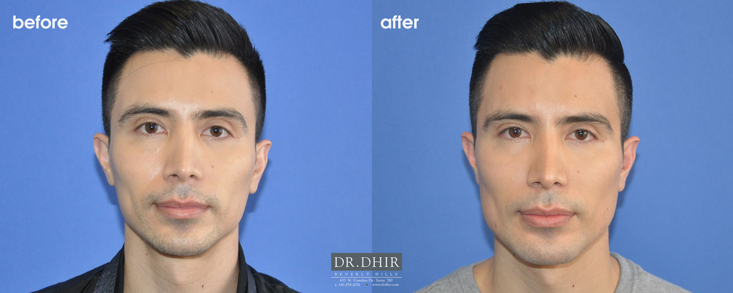 Front view of Before and After pictures of a male jaw implant patient