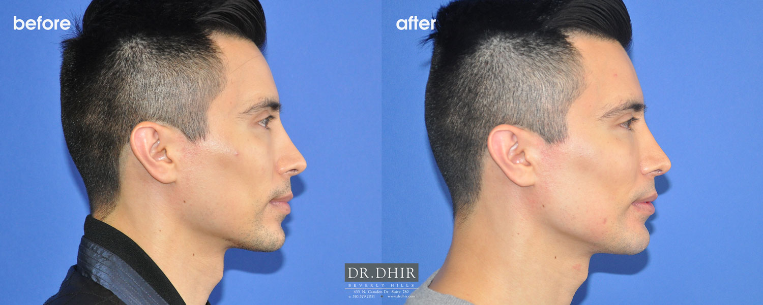 Side view of Before and After pictures of a male jaw implant patient