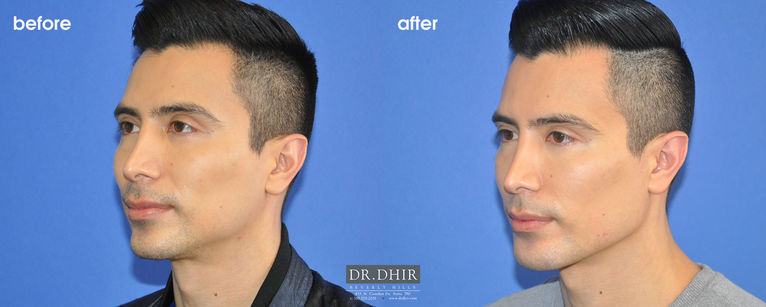 Before and after picture of a jaw implants male patient 3/4th view