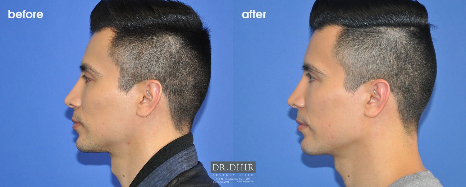 Before and after picture of a jaw implants male patient side view