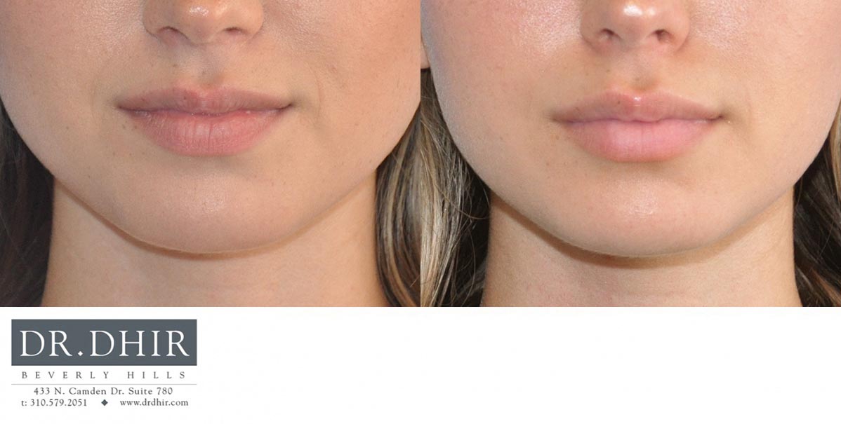 Before and After picture of a lip augmentation female patient front view