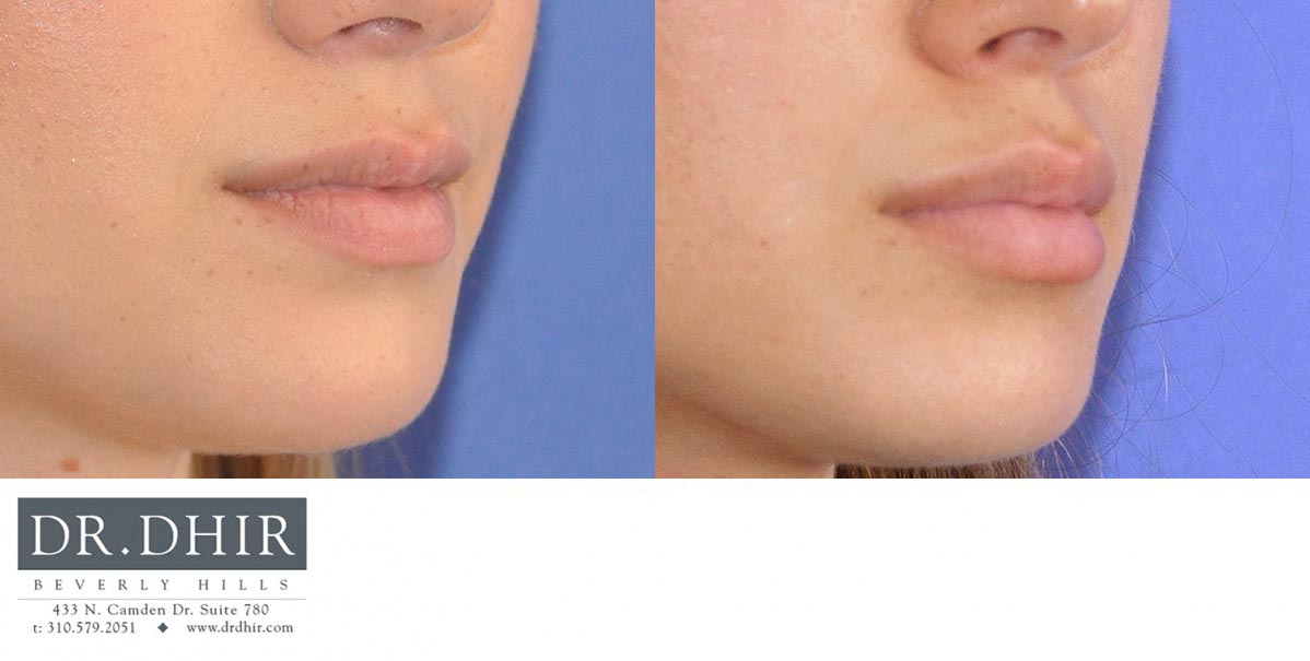 Before and After picture of a lip augmentation female patient side view