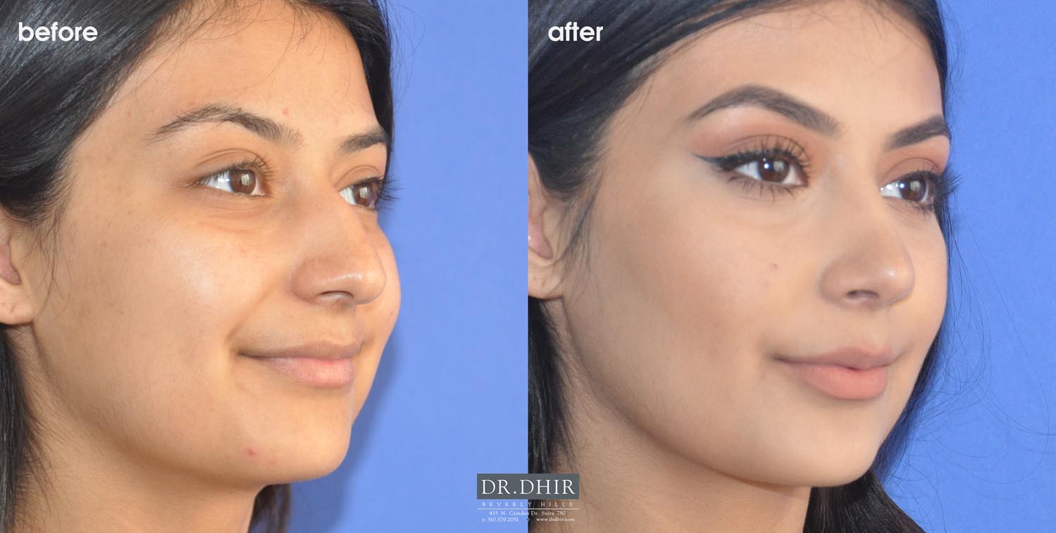 3/4th view of Before and After picture of a Rhinoplasty female patient