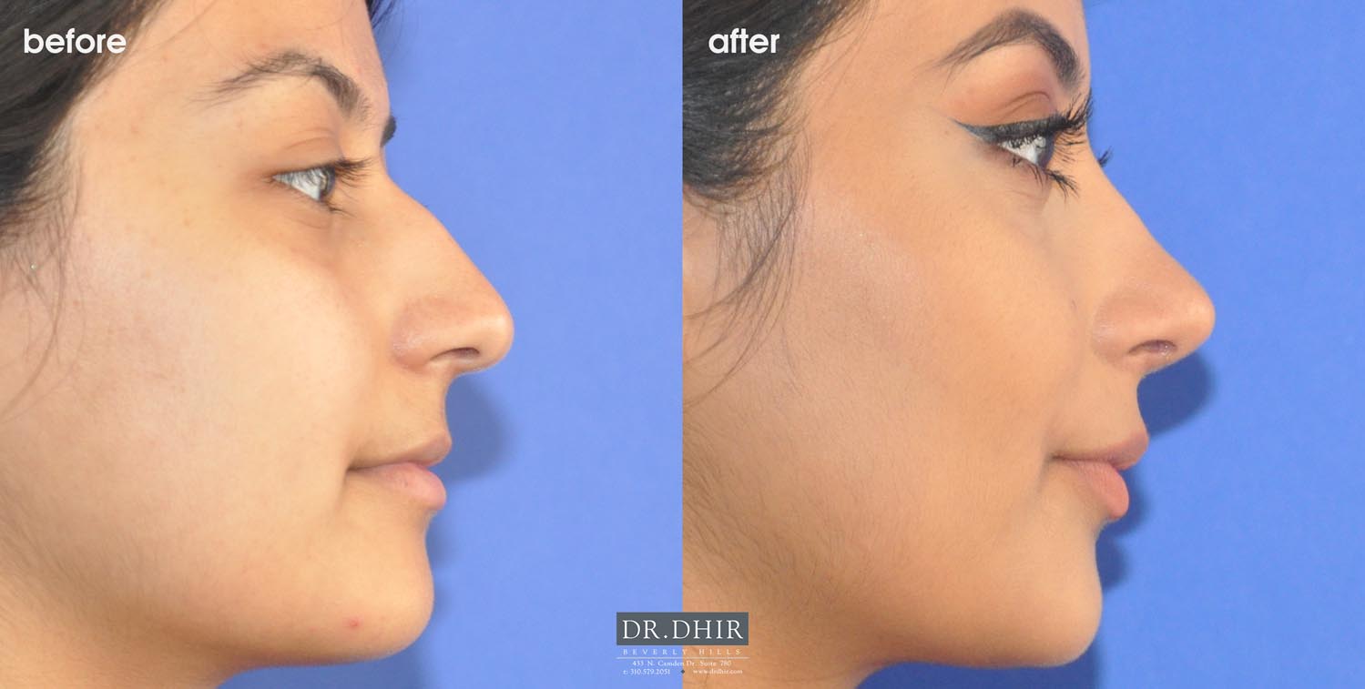 Side view of Before and After picture of a Rhinoplasty female patient